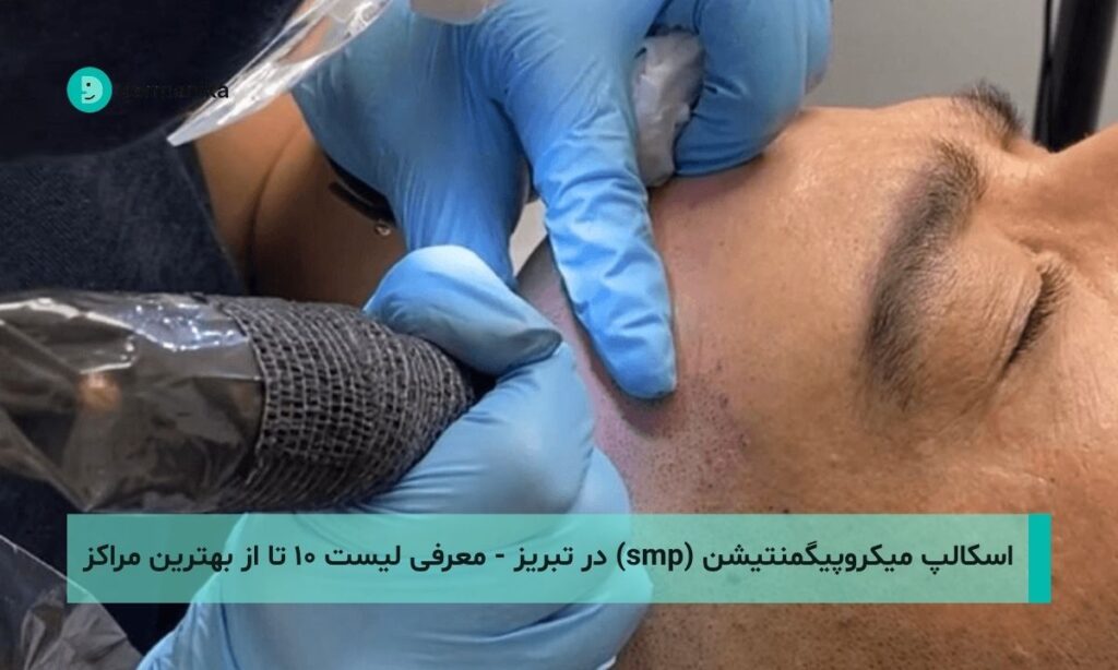 اسکالپ میکروپیگمنتیشن (smp) در تبریز - لیست ۱۰ تا از بهترین مراکز