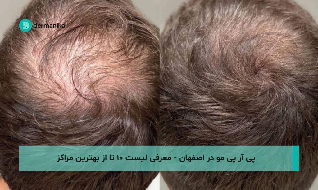 پی آر پی مو در اصفهان - لیست ۱۰ تا از بهترین مراکز