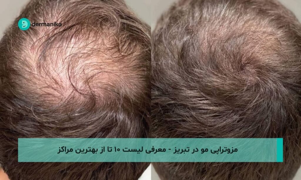 مزوتراپی مو در تبریز - معرفی لیست ۱۰ تا از بهترین مراکز