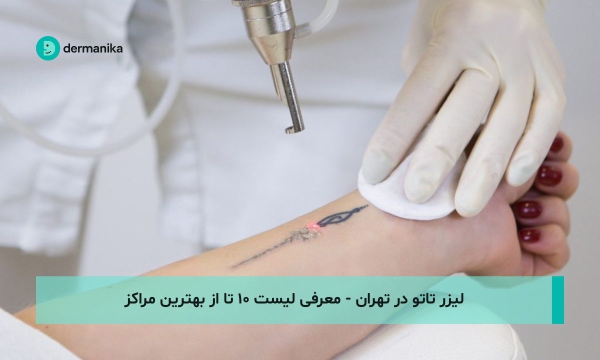 لیزر تاتو در تهران - معرفی لیست ۱۰ تا از بهترین مراکز
