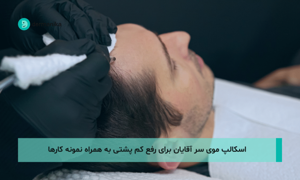 اسکالپ موی سر آقایان برای رفع کم پشتی به همراه نمونه کارها