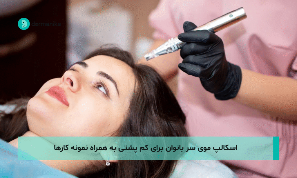 اسکالپ موی سر بانوان برای کم پشتی به همراه نمونه کارها