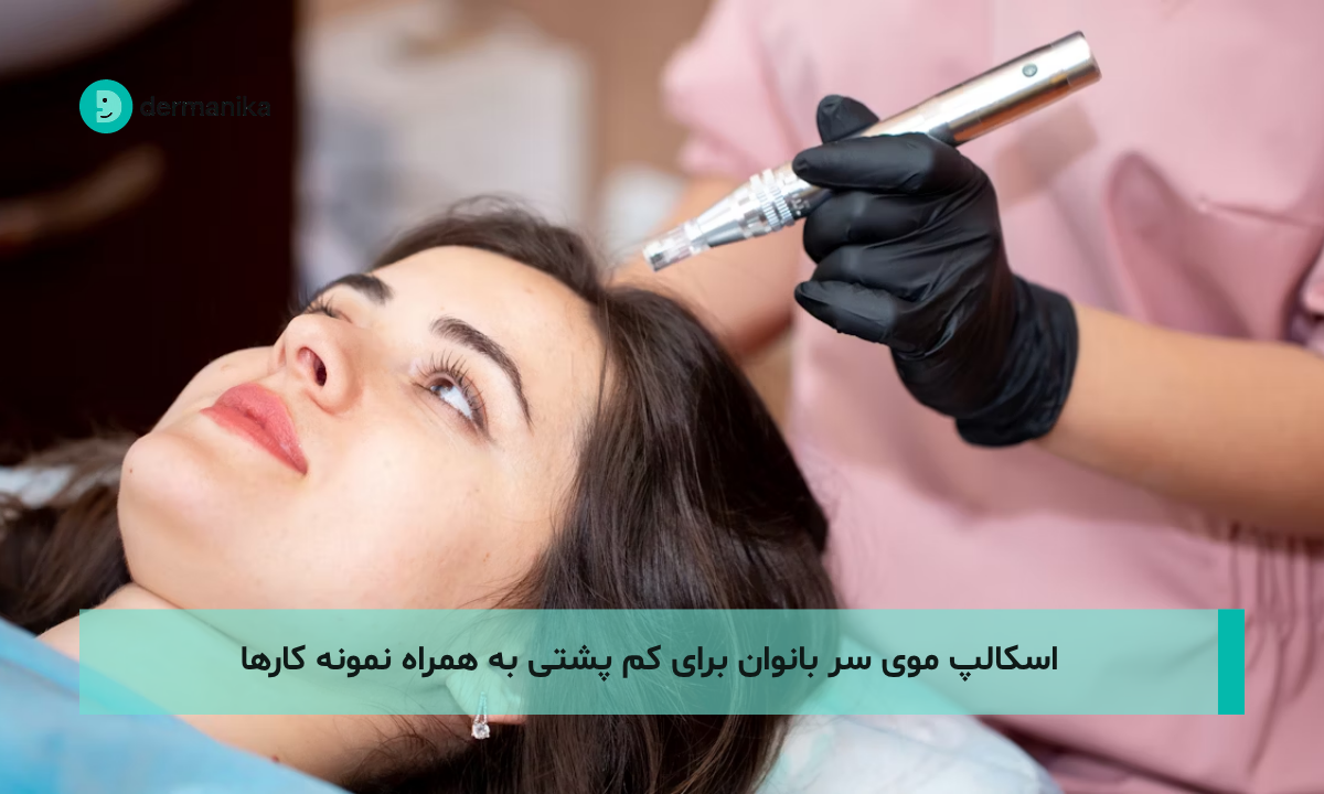 اسکالپ موی سر بانوان برای کم پشتی به همراه نمونه کارها