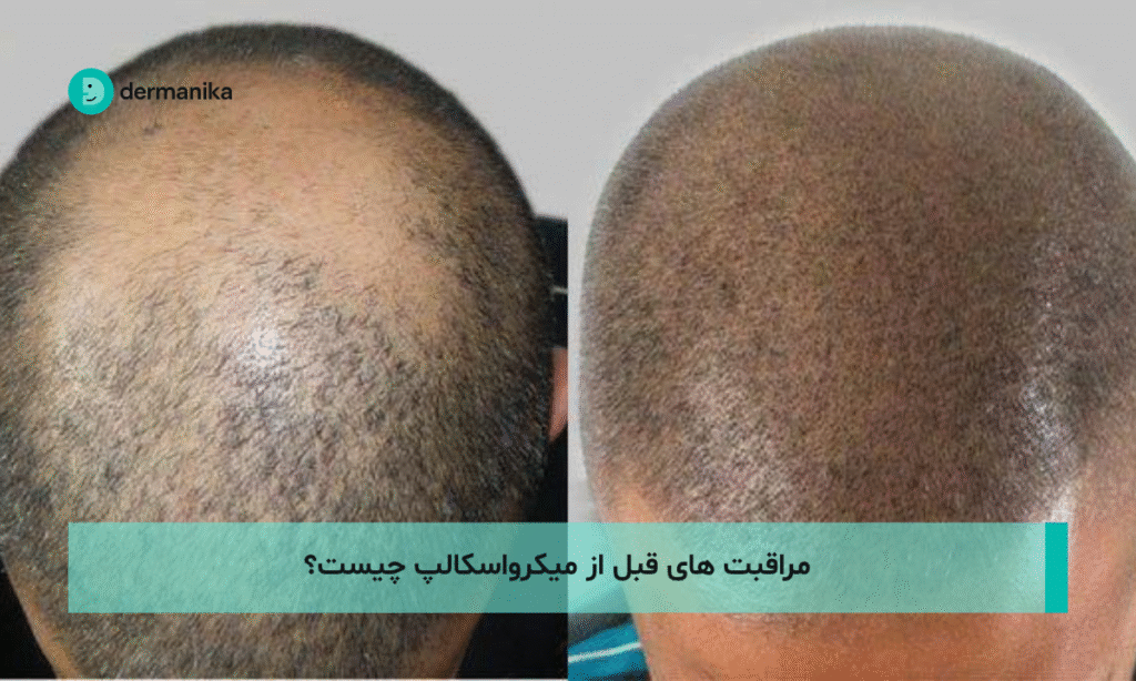 مراقبت های قبل از میکرواسکالپ چیست؟