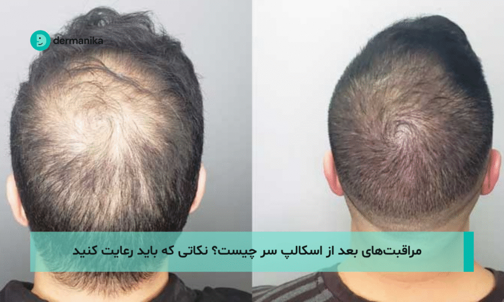مراقبت‌های بعد از اسکالپ سر چیست؟ نکاتی که باید رعایت کنید