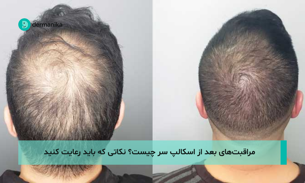 مراقبت‌های بعد از اسکالپ سر چیست؟ نکاتی که باید رعایت کنید