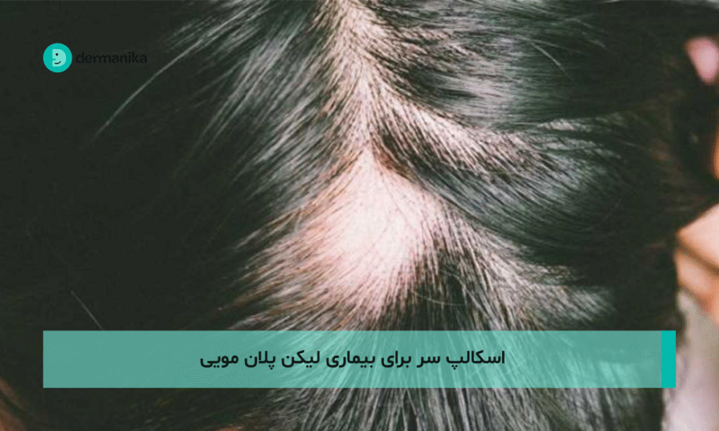 اسکالپ سر برای بیماری لیکن پلان مویی