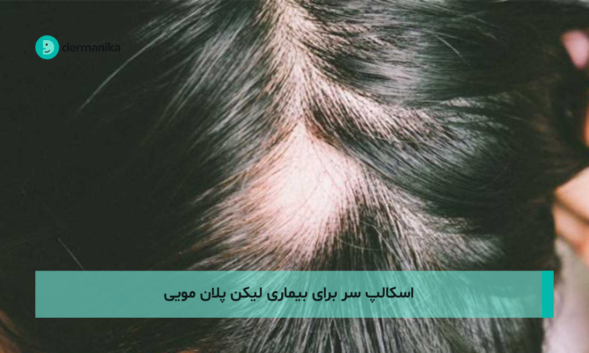 اسکالپ سر برای بیماری لیکن پلان مویی