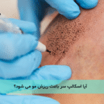 آیا اسکالپ سر باعث ریزش مو می شود؟