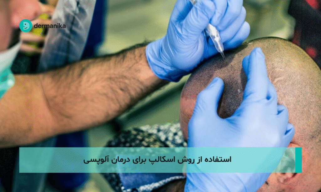 استفاده از روش اسکالپ برای درمان آلوپسی