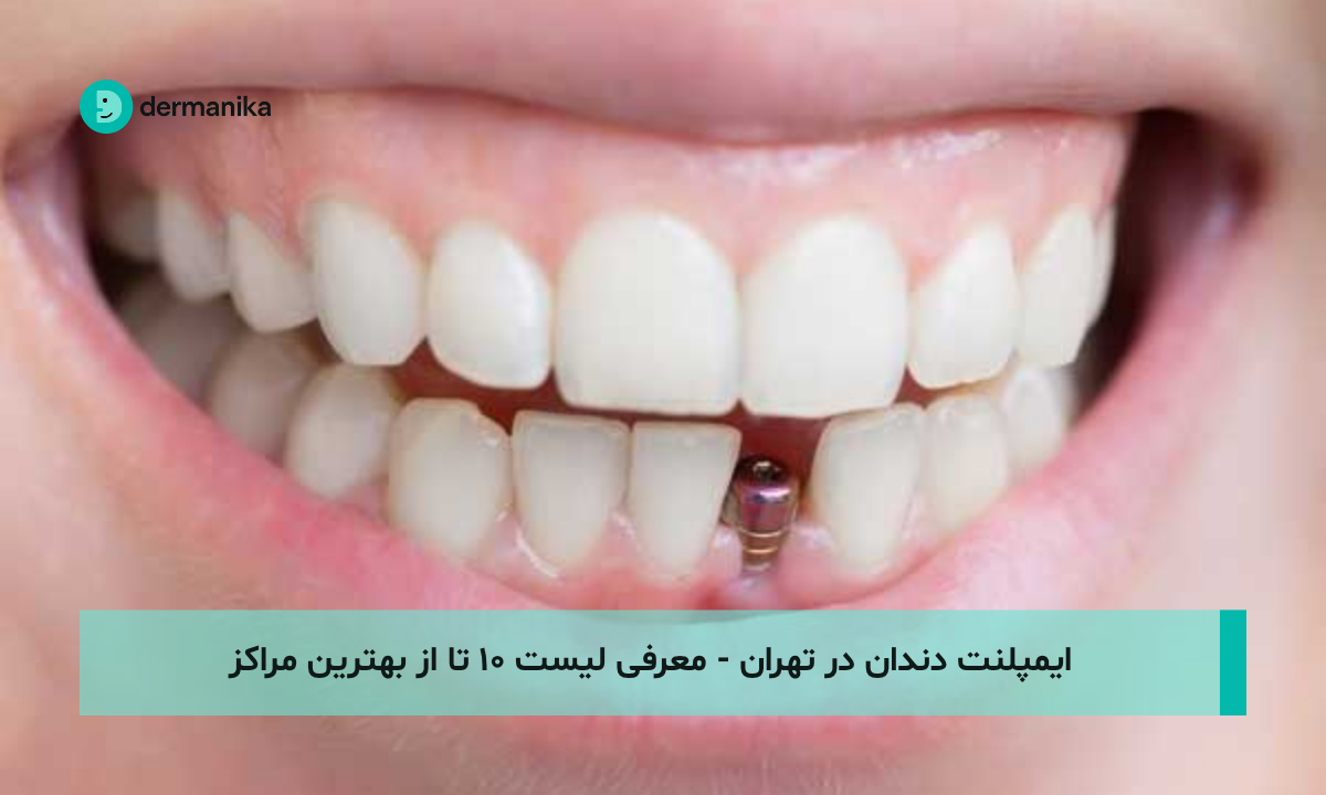 ایمپلنت دندان در تهران - معرفی لیست ۱۰ تا از بهترین مراکز