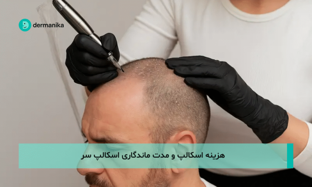 هزینه اسکالپ و مدت ماندگاری اسکالپ سر