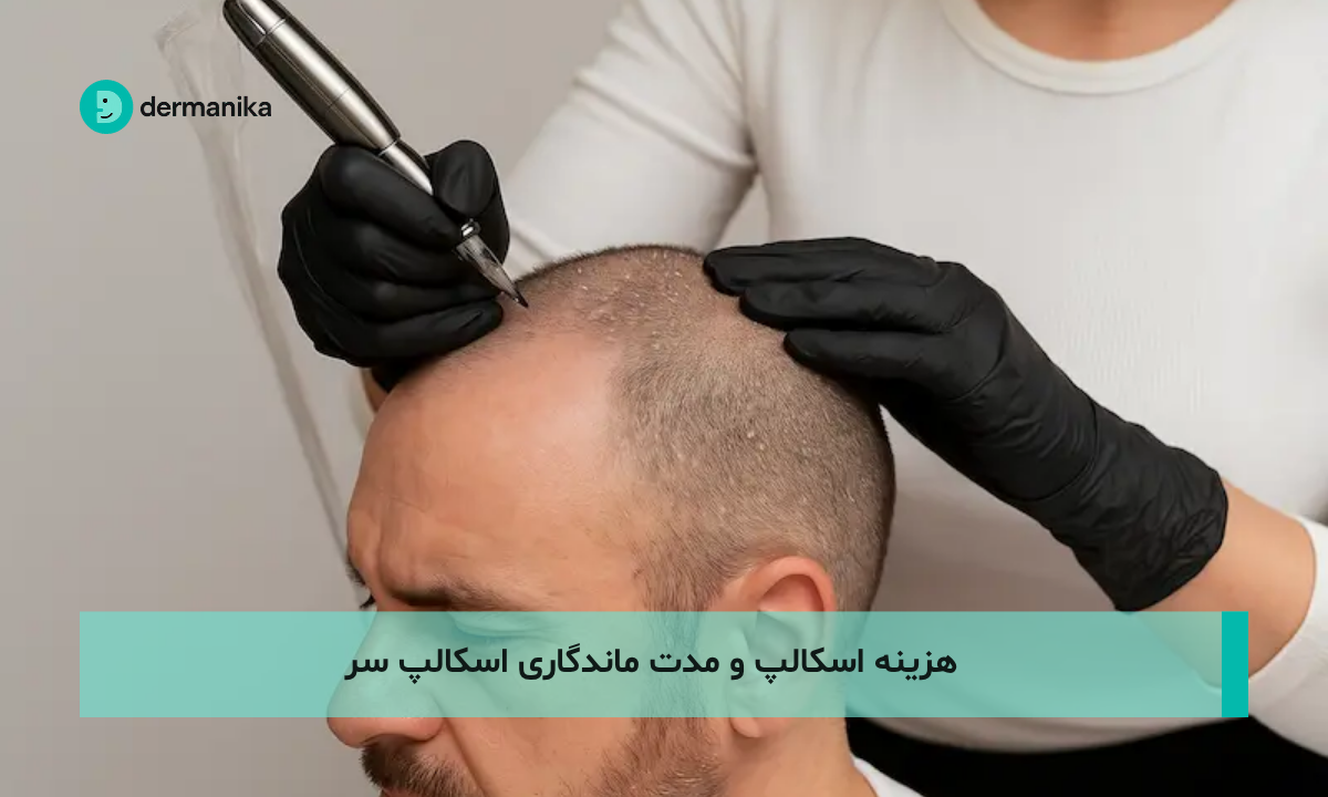 هزینه اسکالپ و مدت ماندگاری اسکالپ سر