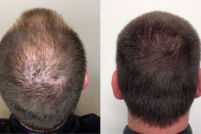 مراحل انجام اسکالپ سر آقایان