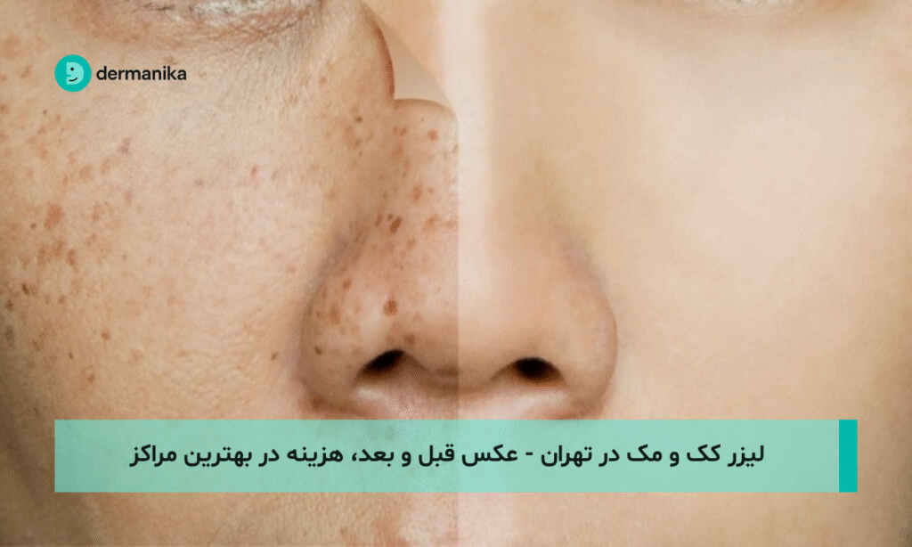 لیزر کک و مک در تهران - عکس قبل و بعد، هزینه در بهترین مراکز