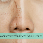 لیزر کک و مک در تهران - عکس قبل و بعد، هزینه در بهترین مراکز