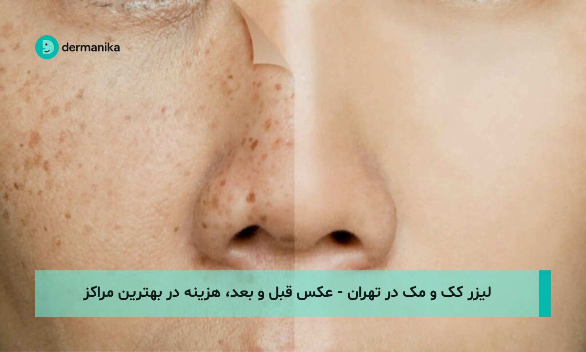 لیزر کک و مک در تهران - عکس قبل و بعد، هزینه در بهترین مراکز