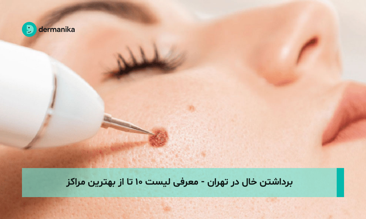 برداشتن خال در تهران - معرفی لیست ۱۰ تا از بهترین مراکز