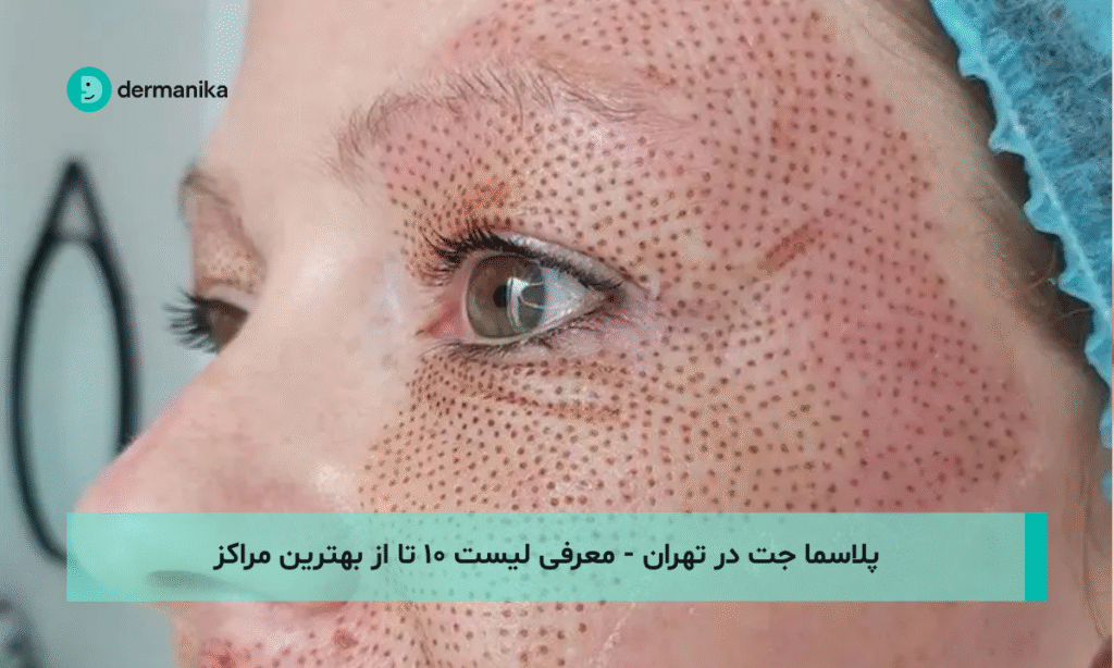 پلاسما جت در تهران - معرفی لیست ۱۰ تا از بهترین مراکز