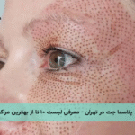 پلاسما جت در تهران - معرفی لیست ۱۰ تا از بهترین مراکز