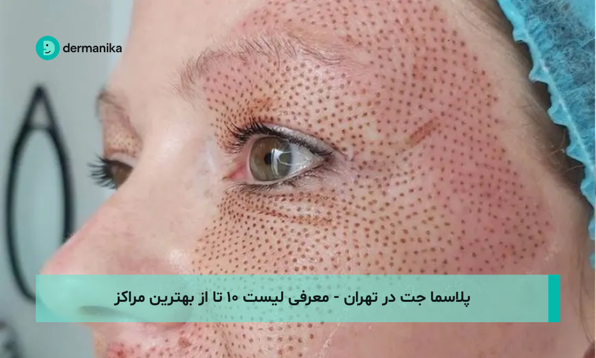 پلاسما جت در تهران - معرفی لیست ۱۰ تا از بهترین مراکز