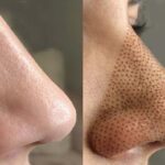 بهترین مرکز پلاسما بینی در تهران + تلفن و آدرس